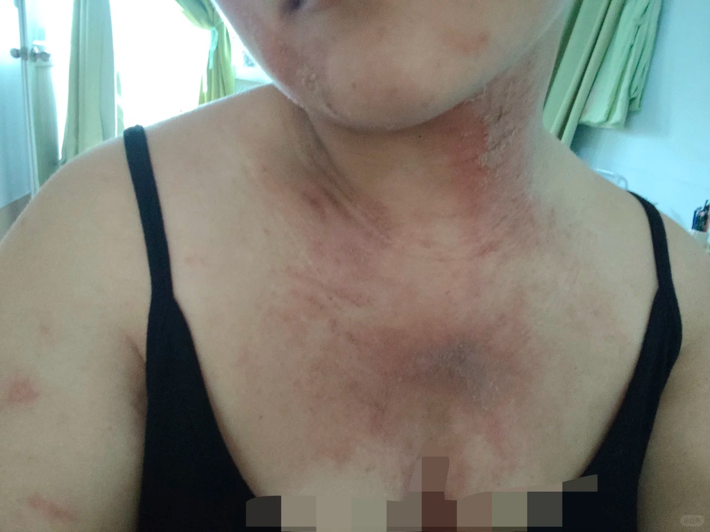 隐翅虫咬了后的症状图片 