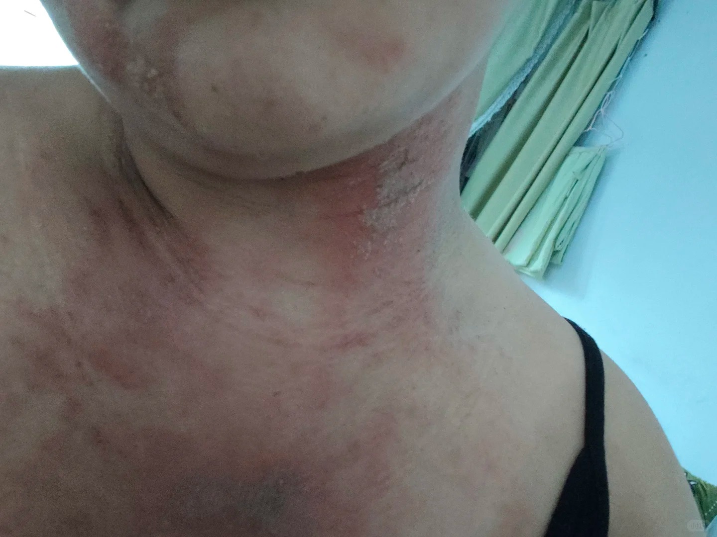 隐翅虫咬了后的症状图片 