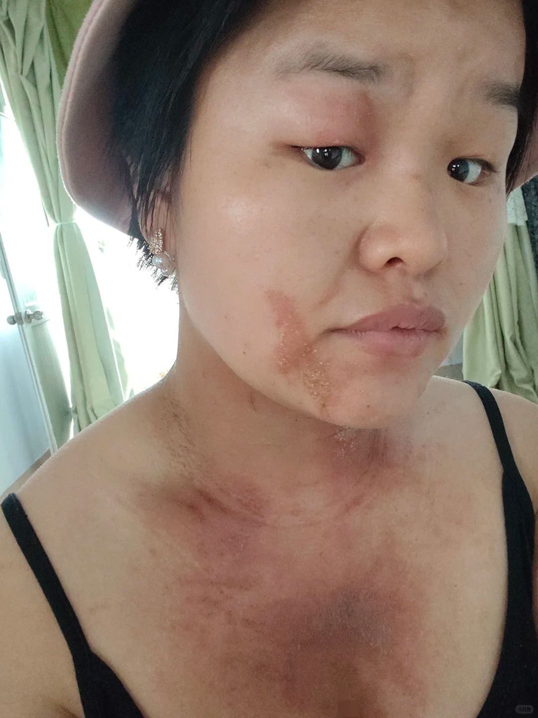 隐翅虫咬了后的症状图片 